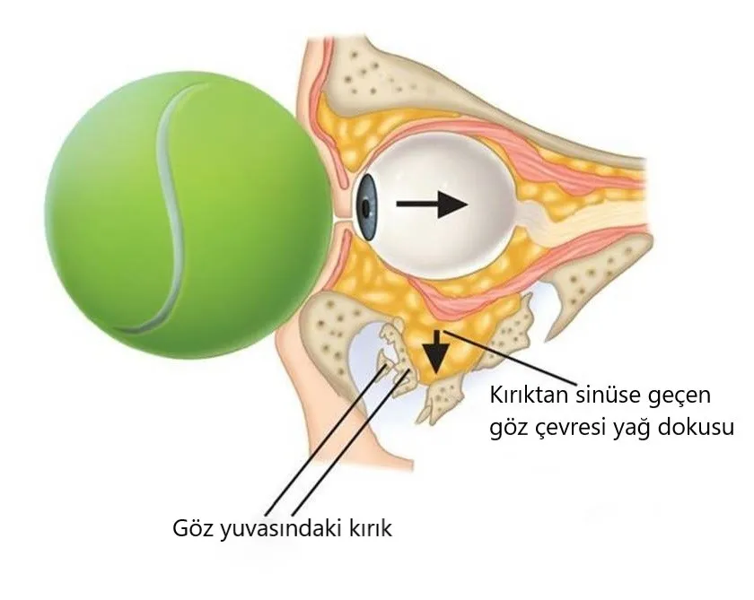 TENİS’te POTANSİYEL TEHLİKE: BLOW OUT KIRIKLARI!